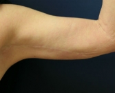 Feel Beautiful - Arm reduction San Diego Case 3 - After Photo